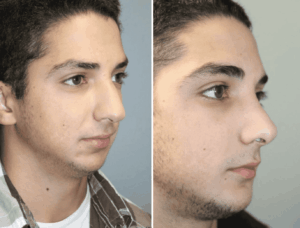 A close-up of a patient's nose showing the effects of a rhinoplasty near Brentwood, TN.